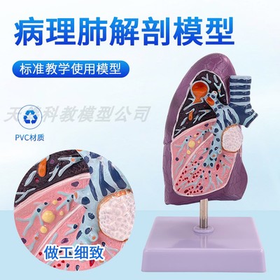 病变肺模型 病理肺解剖 吸烟者内脏 病态肺部切面 呼吸系统模型