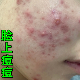 脸上痘痘脸颊长红肿疙瘩脓包痘痘腮边痘学生青春痘男女脸上长痘痘