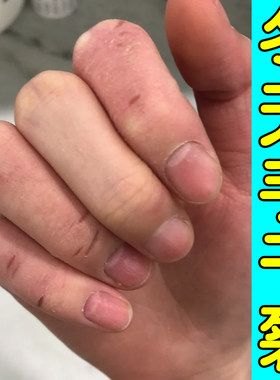 冬天手干裂修复霜手起皮掉皮换季手指关节裂口子手开裂蜕皮膏