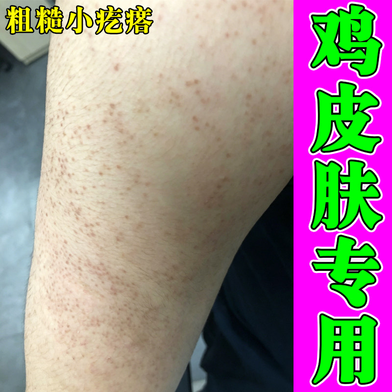 手臂鸡皮毛囊堵塞起红肿丘脓包毛周角化症胳膊有小颗粒长疙瘩粗糙