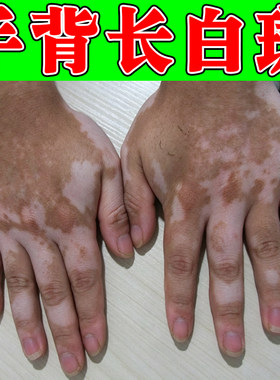手背长白斑促进黑色素生长补骨脂酊手上肤色不均有白色斑点块