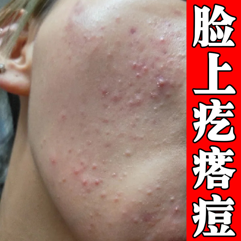 脸上疙瘩痘闭口粉刺痘学生成人熬夜上火长痘青春痘脸颊额头痘乳膏