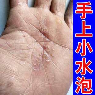 手掌痒刺痒手上脓包手蜕皮燥粗糙手起皮掉皮痒外用软膏