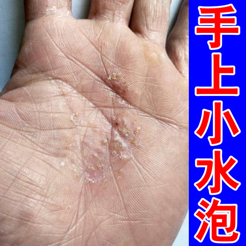 手掌痒刺痒手上脓包手蜕皮燥粗糙手起皮掉皮痒外用软膏