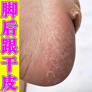 脚后跟干裂脚裂蜕皮脚上脚后跟手脚开裂修复药脚裂口子膏