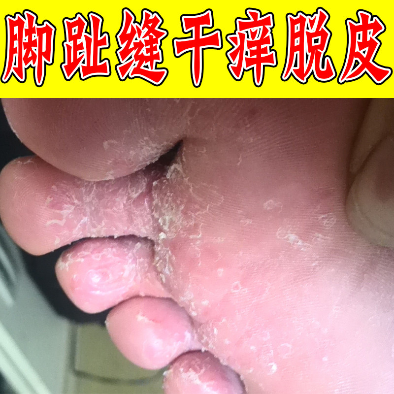 脚趾缝干皮起皮脚底干燥粗糙干脚后跟干裂指缝起皮掉皮
