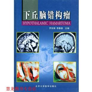 【正版书籍】 下丘脑错构瘤 罗世祺,李春德 主编 北京大学医学出版社
