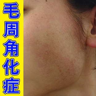 面部颈部红斑黑变病疙瘩毛囊角化脸起皮橘皮干燥膏