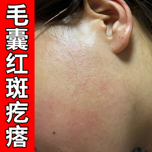 小孩脸上有小颗粒起小疙瘩毛囊红斑黑变病修复外用膏