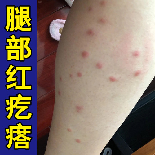 身上起红疙瘩胳膊上长小红点红刺挠外用膏