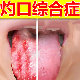灼口综合症的药地图舌调理儿童舌头裂痕麻木裂纹有齿痕舌苔白厚