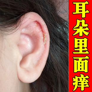 冶耳朵里面外耳道干燥起皮耳廓湿流脓掉屑膏