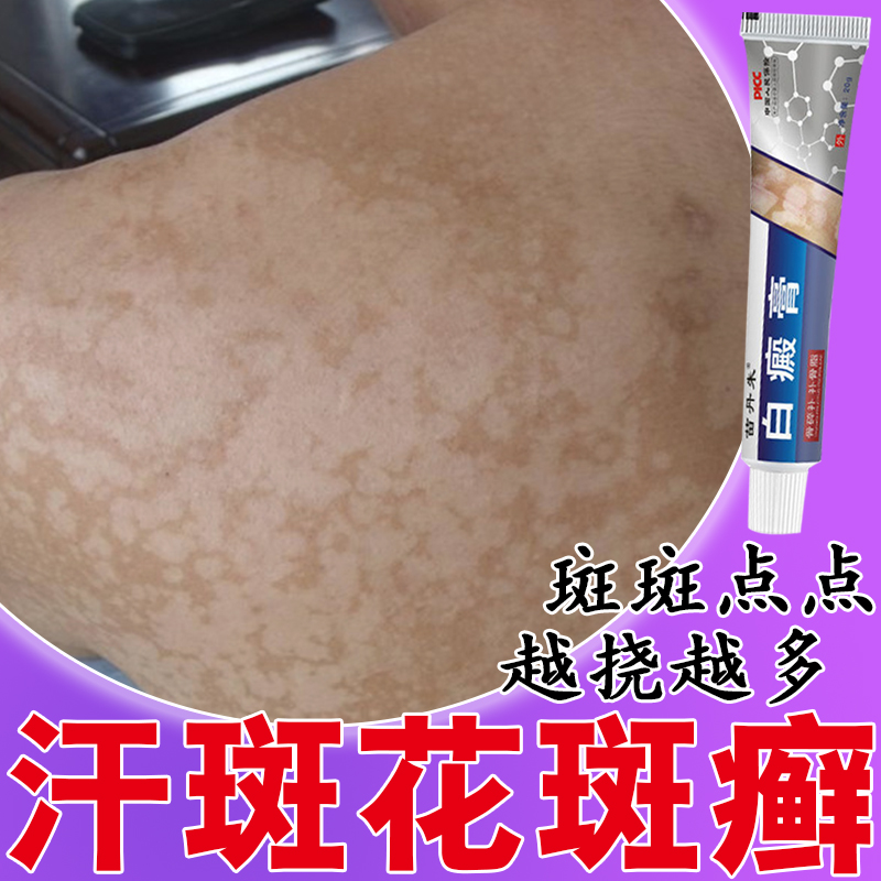 外阴白斑专用药膏止痒去花斑癣根
