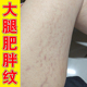 生长纹大腿内侧小腿窝肚子胳膊屁股肥胖纹淡化纹路男女生