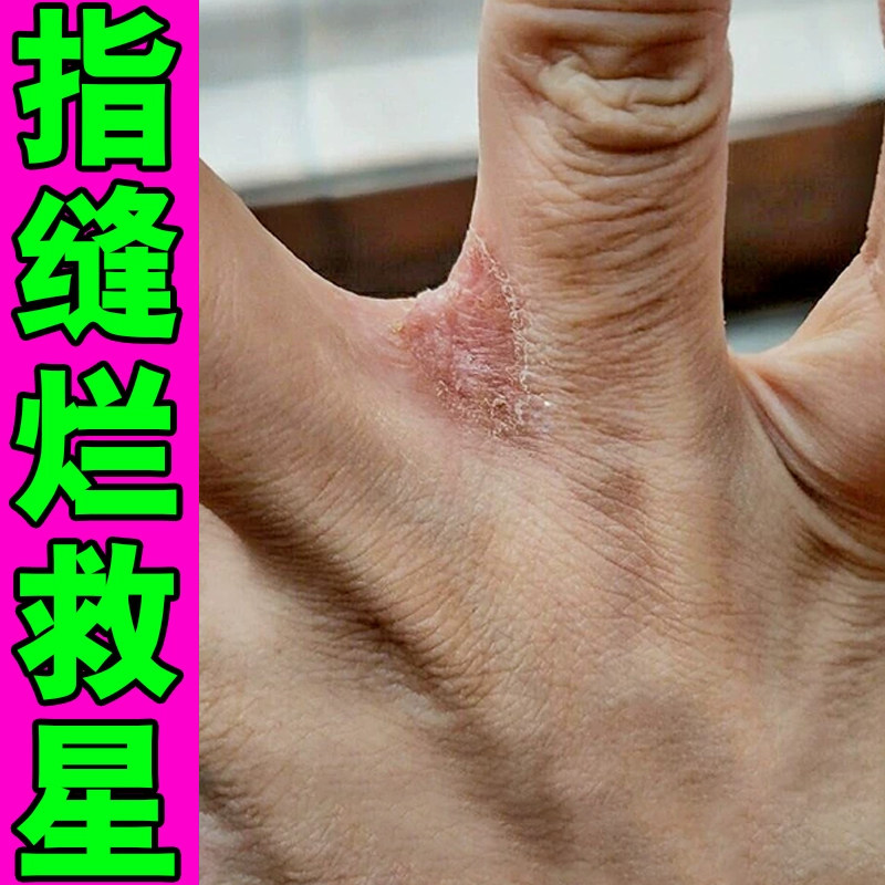 手指缝溃烂烂手丫经常碰水指间干裂发红干燥脱皮痒