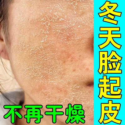 脸干燥起皮有碎屑修复滋润霜换季脸部爆干皮脱皮掉皮发痒皮肤粗糙