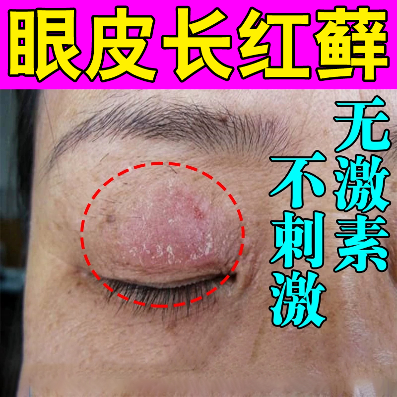 眼皮藓眼睛周围眼角痒干燥起皮掉屑上眼皮痒红肿眼角藓起皮专用膏