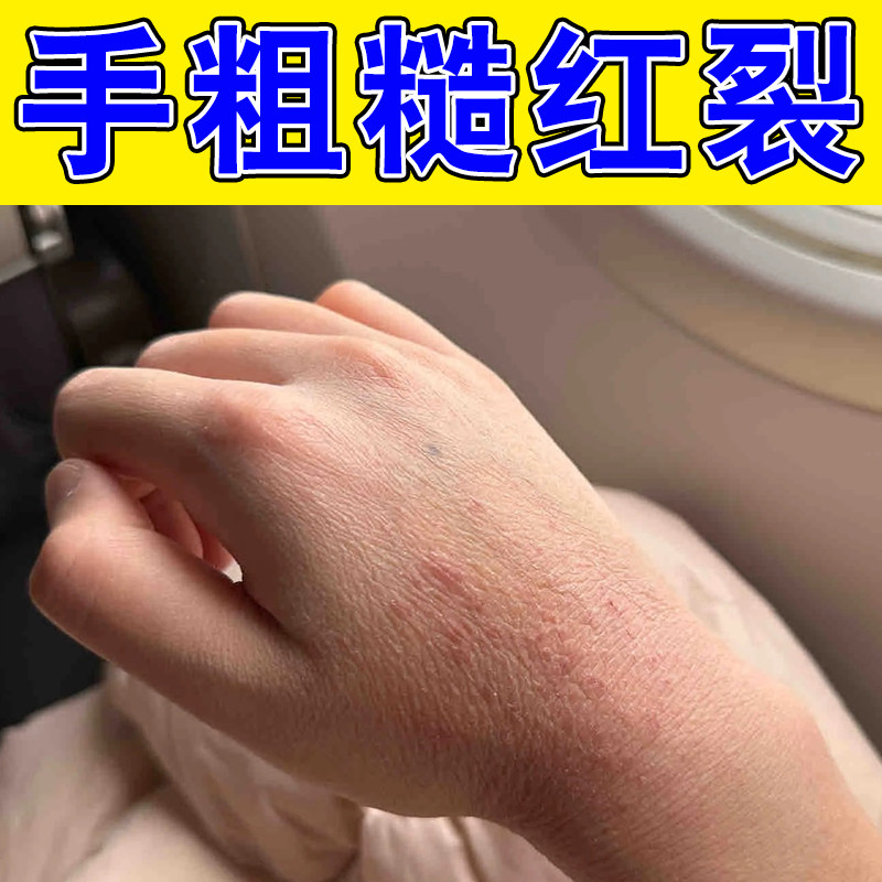 冰口防干裂冬天手背皲裂开冰口脱皮专用软膏冻伤冻疮膏开裂修复膏