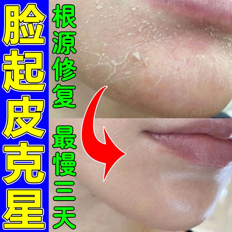 换季脸干燥起皮掉皮屑修复霜脸上起皮脱皮泛红干痒嘴角周围起干皮