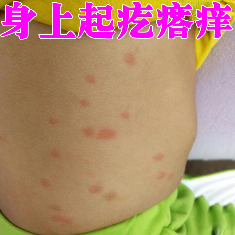 冶疗夏季小孩子出汗身上起红疙瘩夏天天气热湿喷剂