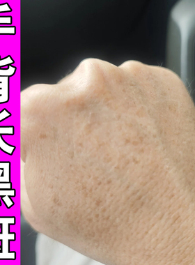 手上老年斑手部脸部日晒黑斑手背晒黑斑黄褐斑黑色素沉淀专用