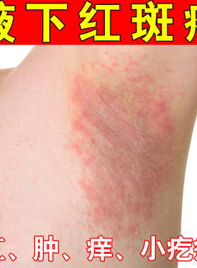 腋毛腋下红斑湿痒红肿长小疙瘩胳肢窝出汗发臭有红肿专用软膏