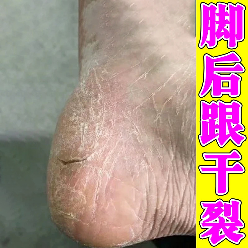 脚后跟干裂起硬皮足跟开裂修复霜脚底脱皮痒真菌感染去死皮专用膏