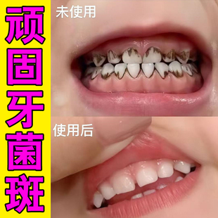 牙根发黑牙垢牙菌斑牙烟渍牙斑净牙缝发黑清理氟斑牙