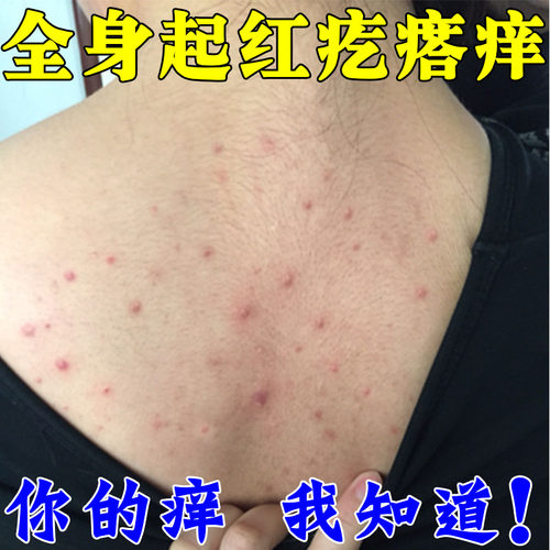 身上起红疙瘩痒毛囊炎豆豆老人皮肤干燥痒孩子全身痒外用喷剂