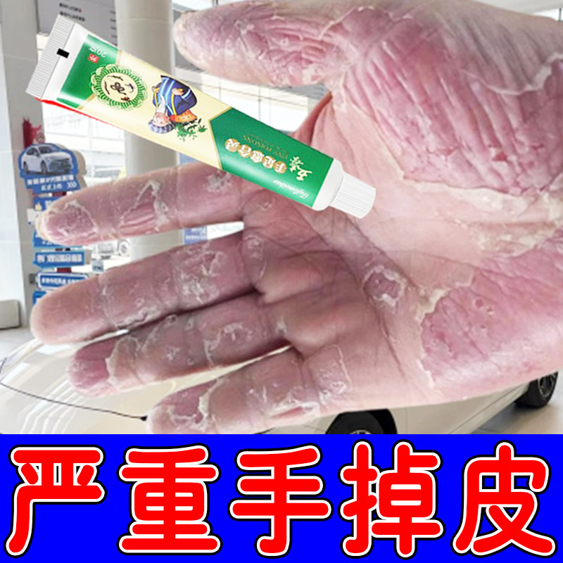 手脱皮专用手严重脱皮专用真菌感染蜕皮手指手掌手心干燥起皮干裂