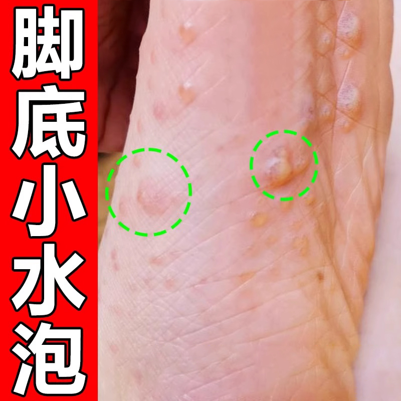 脚底上起小水泡又痒又脱皮脚痒掉皮脚丫痒脚脱皮痒喷雾