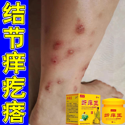 结节痒疙瘩顽固痒疹小腿痒腿部红斑过敏硬疙瘩痒蚊虫叮咬肿胀疙瘩