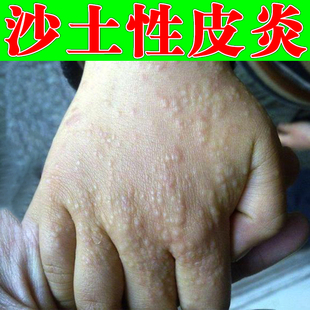 沙土性手背起小疙瘩儿童小孩玩沙土水泥巴接触性沙土皮肤