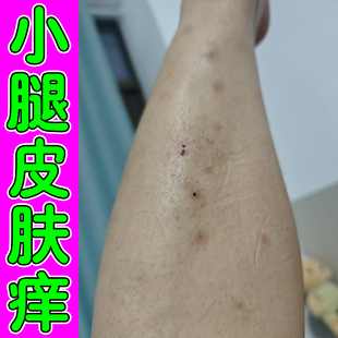 小腿皮肤腿部干燥起皮腿上长红斑全身外用腿部干起小红点