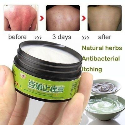 25g Natural Herbal Ointment Psoriasi Cream Effective For