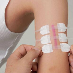 Band-Aid Zipper Tie Wound Closure Patch Hemostatic Patch Wou