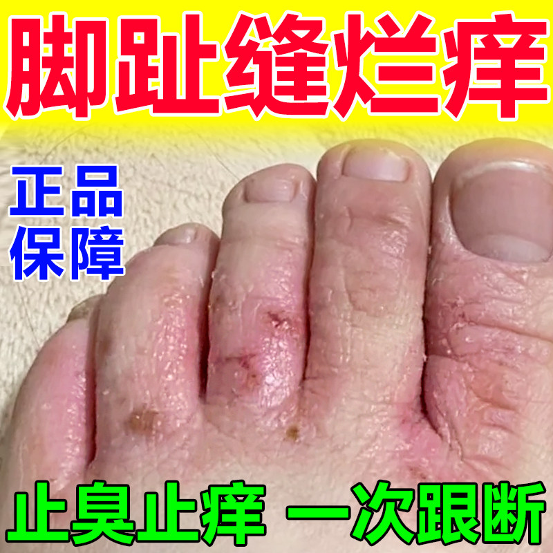 脚气烂脚丫药脱皮糜烂脚趾缝烂痒止脚丫子开裂一次净杀菌止痒草膏