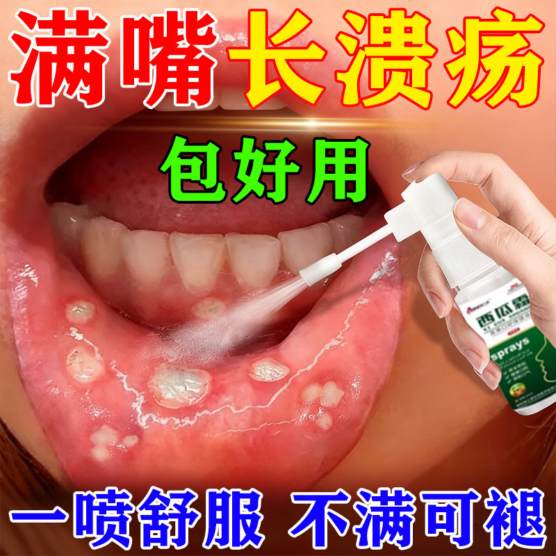 日本口腔溃疡喷雾剂一点灵口腔溃疡口舌生疮嘴巴上火起泡专用贴药