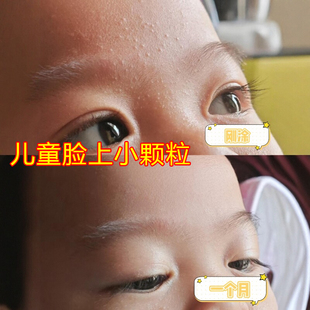 小孩脸上有小颗粒儿童额头起小疙瘩脸颊两边长痘鸡皮疙瘩无刺激