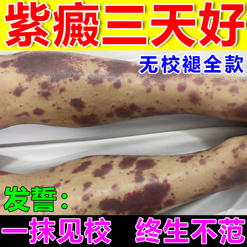 治疗色素过敏性紫癜性皮炎特效药