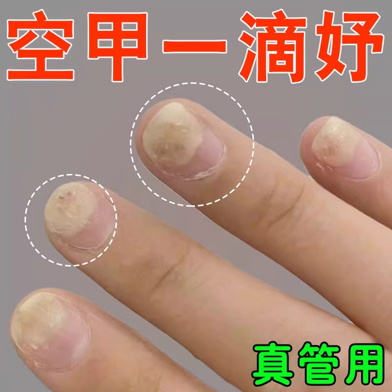 空甲分离修复甲肉分离甲面开裂受损护甲中间空甲床增厚指甲竖纹用