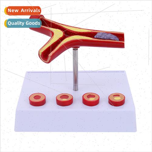 Vessel/clogging Blood concentration fat Pathology blood Vasc