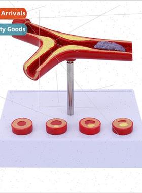 Vessel/clogging Blood concentration fat Pathology blood Vasc