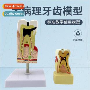 Tooth Decay Model Dental Disease Comprehensive Pathology Mod