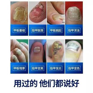 正牌灰指甲特效药水专用凤仙花抑菌液亮甲正品一滴净脱甲精油日本