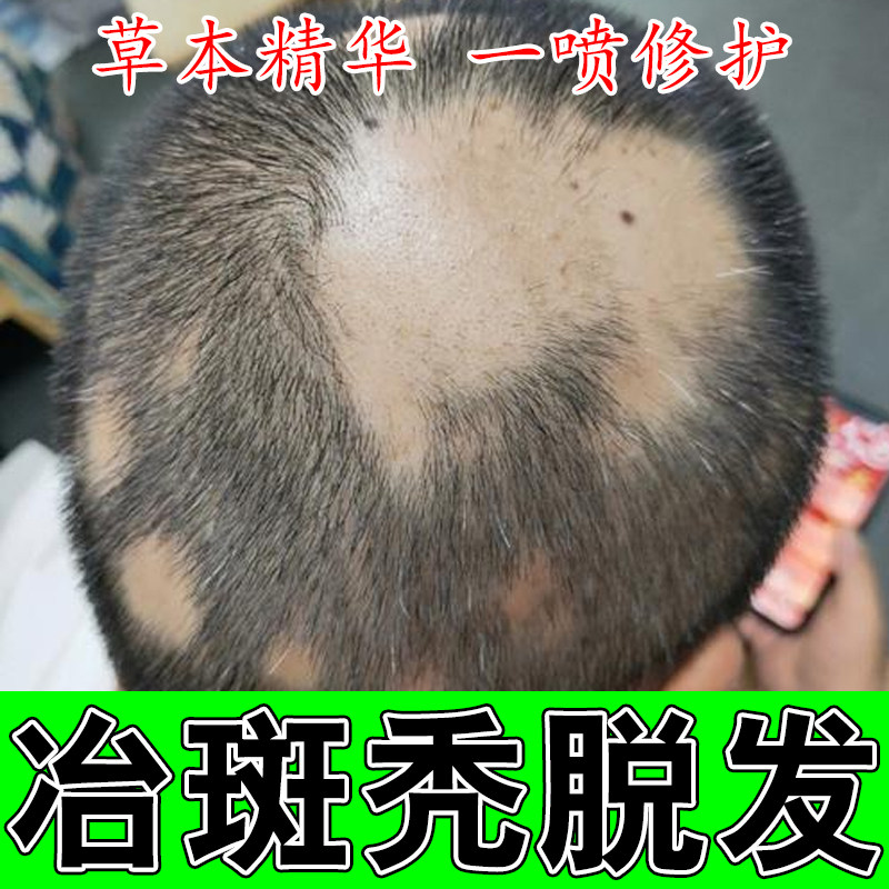 头顶斑秃毛囊变少掉发后脑勺光秃露头皮修护受损发根深层修护喷剂
