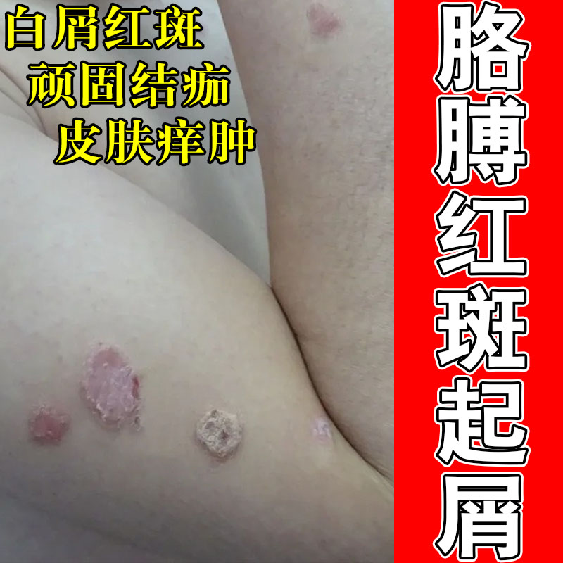 常年身上起屑红肿干皮粗糙红肿发痒起白屑手泛红温和修护软膏