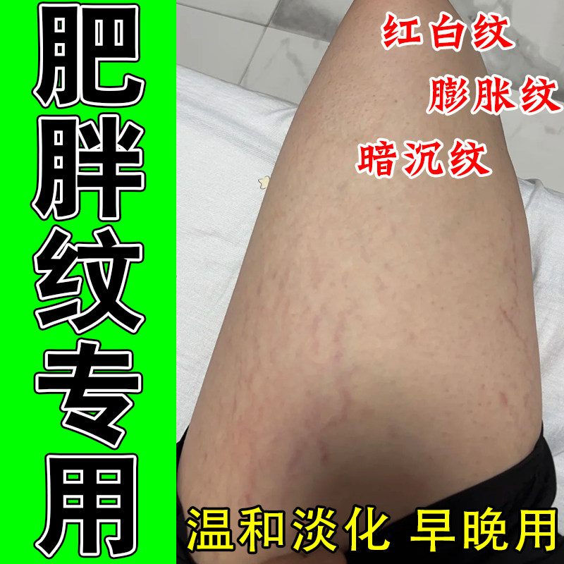 去肥胖纹修复膏生长纹淡化大腿学生去男淡化纹路淡肥胖纹修复膏