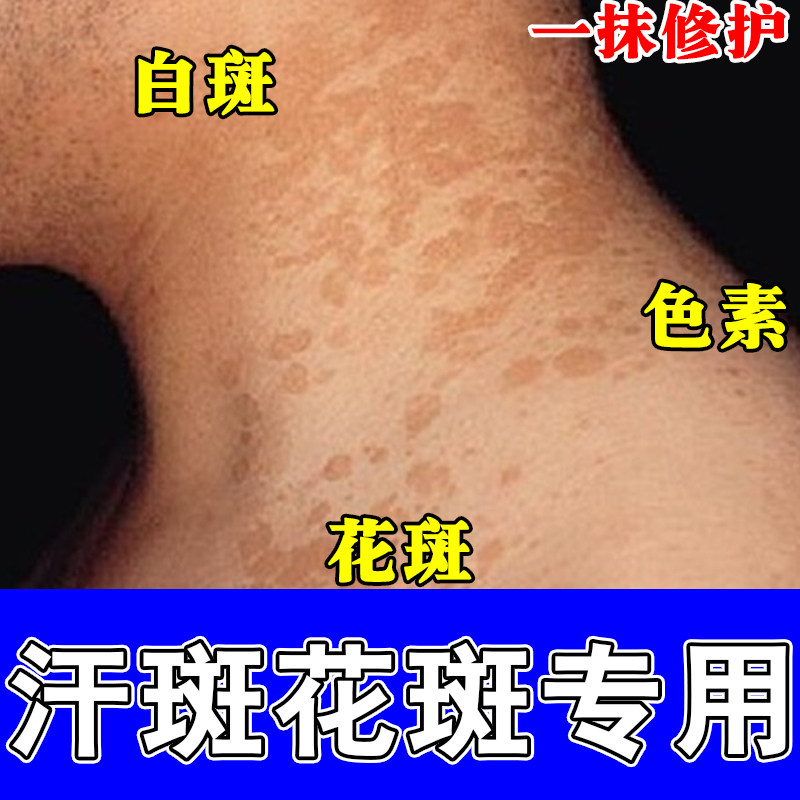 汗斑净花斑乳膏胸前后背腋下白斑红深斑皮肤用膏汗斑净草本膏