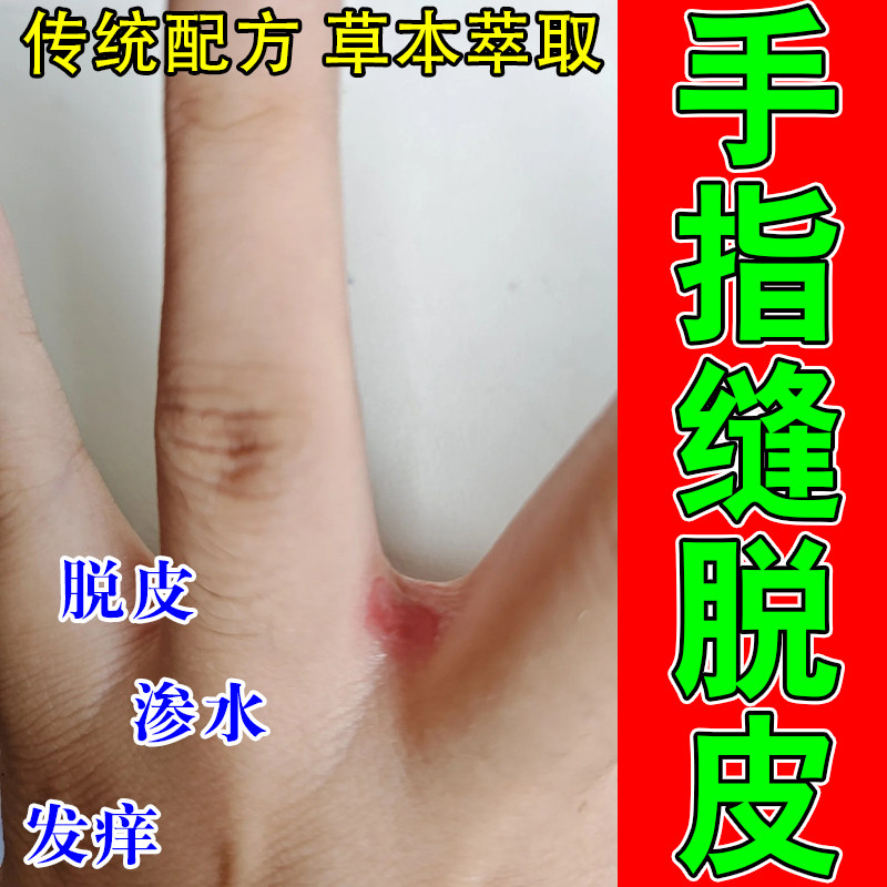 起皮手丫红痒手指缝脱皮发红脱皮膏乳经常碰水手指间干裂起皮用膏